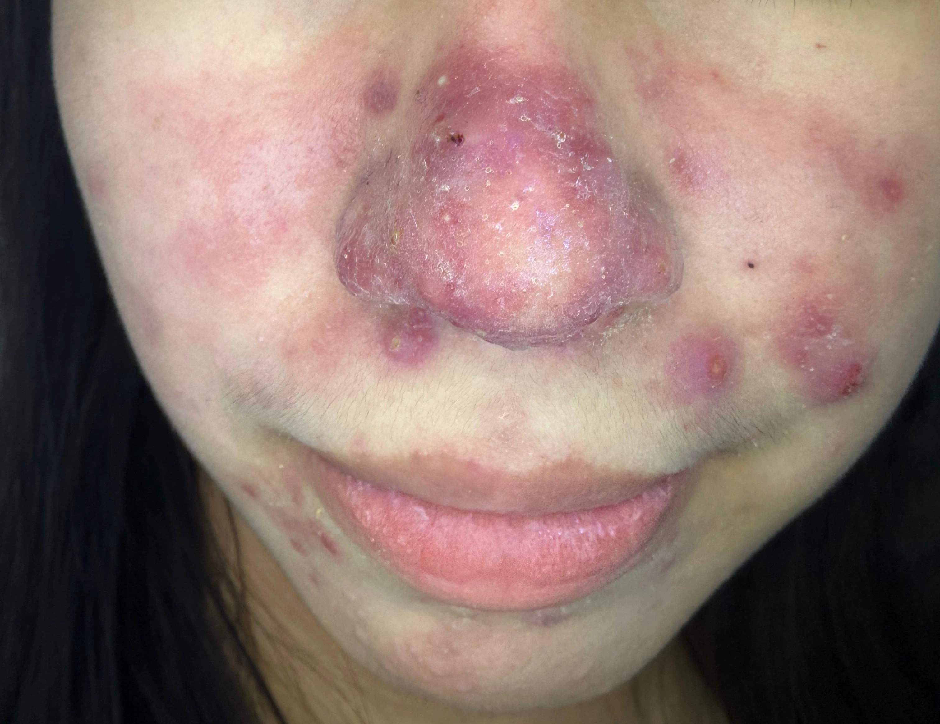 Tratamiento de Rosácea - Antes